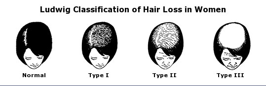 Ludwig Classification of women's hair loss
