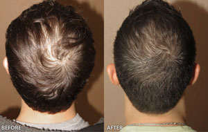 Men's Hair Loss solutions