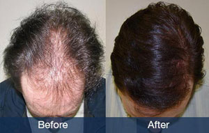 Men's Hair Graft solutions