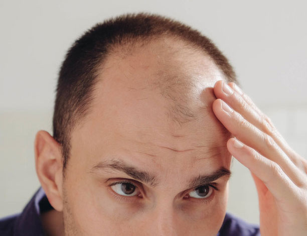 men's hair loss Androgenetic Alopecia