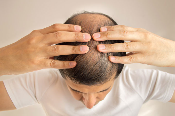 Men's Hair Loss Causes