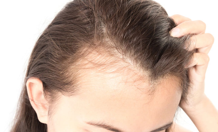 Women's Hair Loss Causes